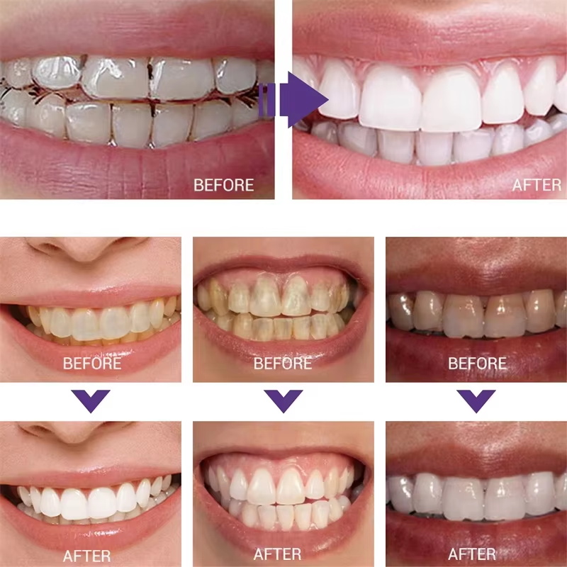 치아 미백 치약 화이트닝 젤 화이트너 표백제 얼룩 제거 - Teeth Whitening Korea 리뷰 및 가격