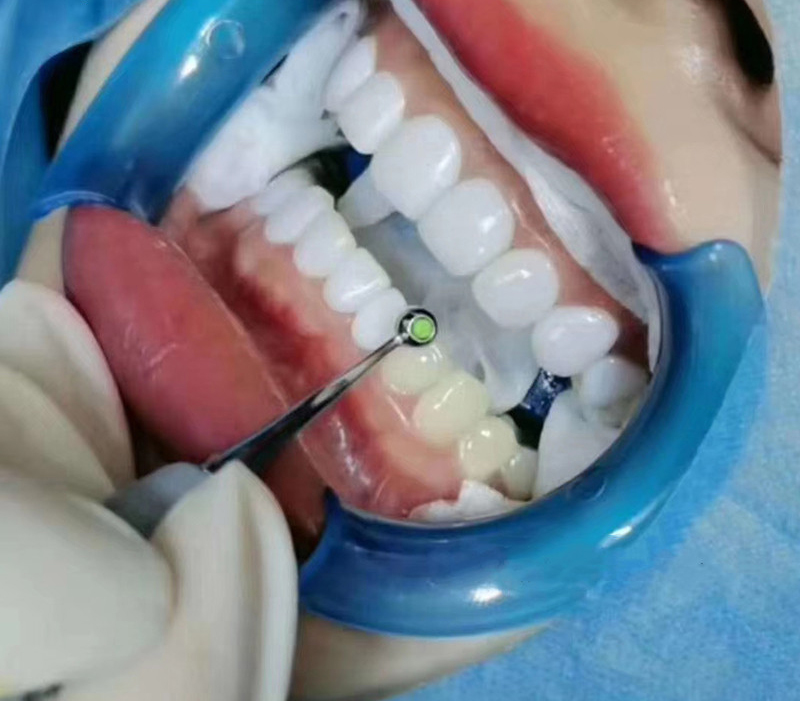 치과 수지 충전 주걱 치과 성형 패드 전방 및 후방 복 - Teeth Whitening Foam Toothpaste 리뷰 및 가격